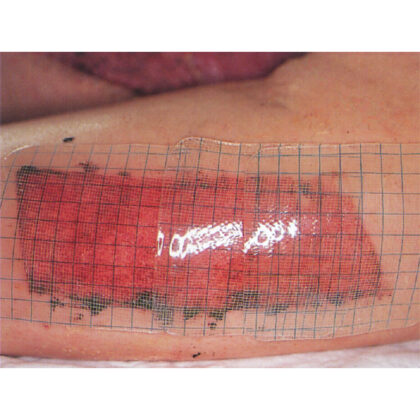 Suprasorb G - hydrogel verbanden